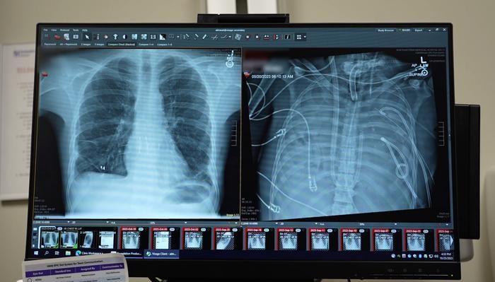 Paciente sobrevive mais de 48 horas sem pulmões após médicos criarem sistema artificial antes de transplante