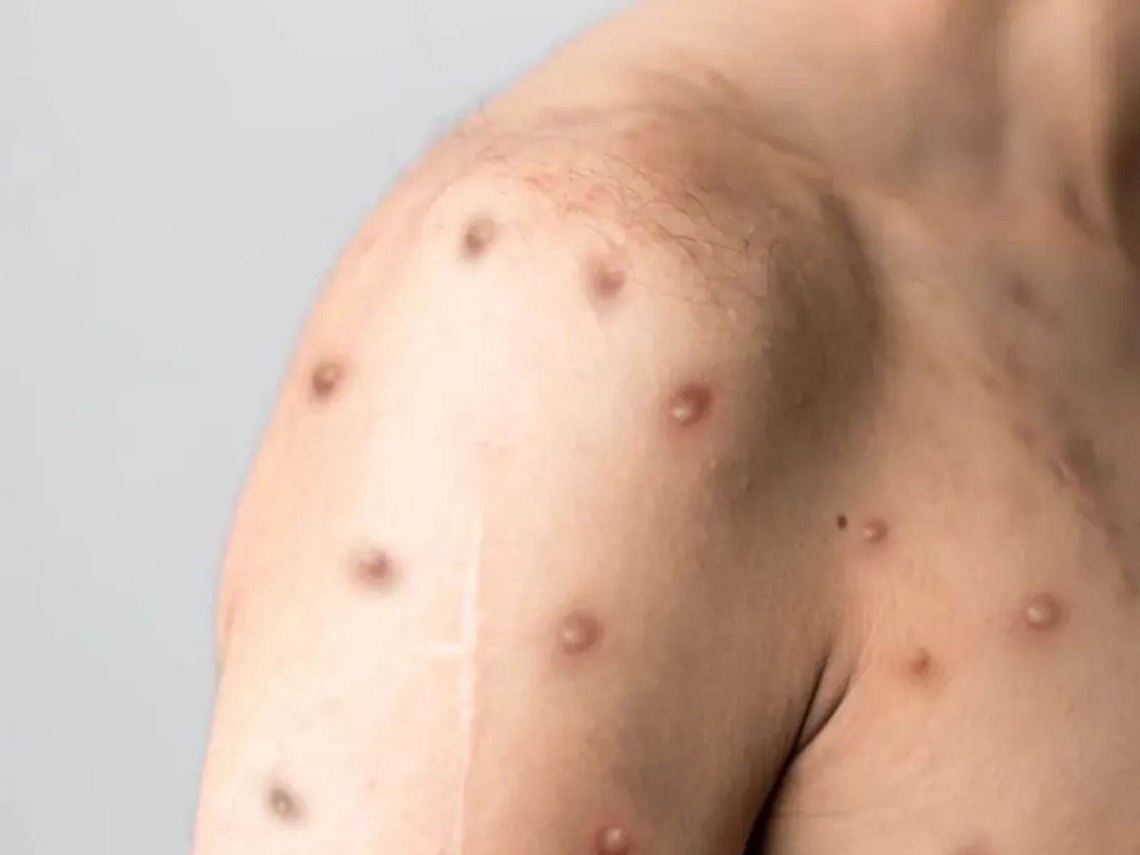 Mpox mata? Pega pelo ar? Beijo transmite? g1 responde às principais buscas do Google sobre a doença