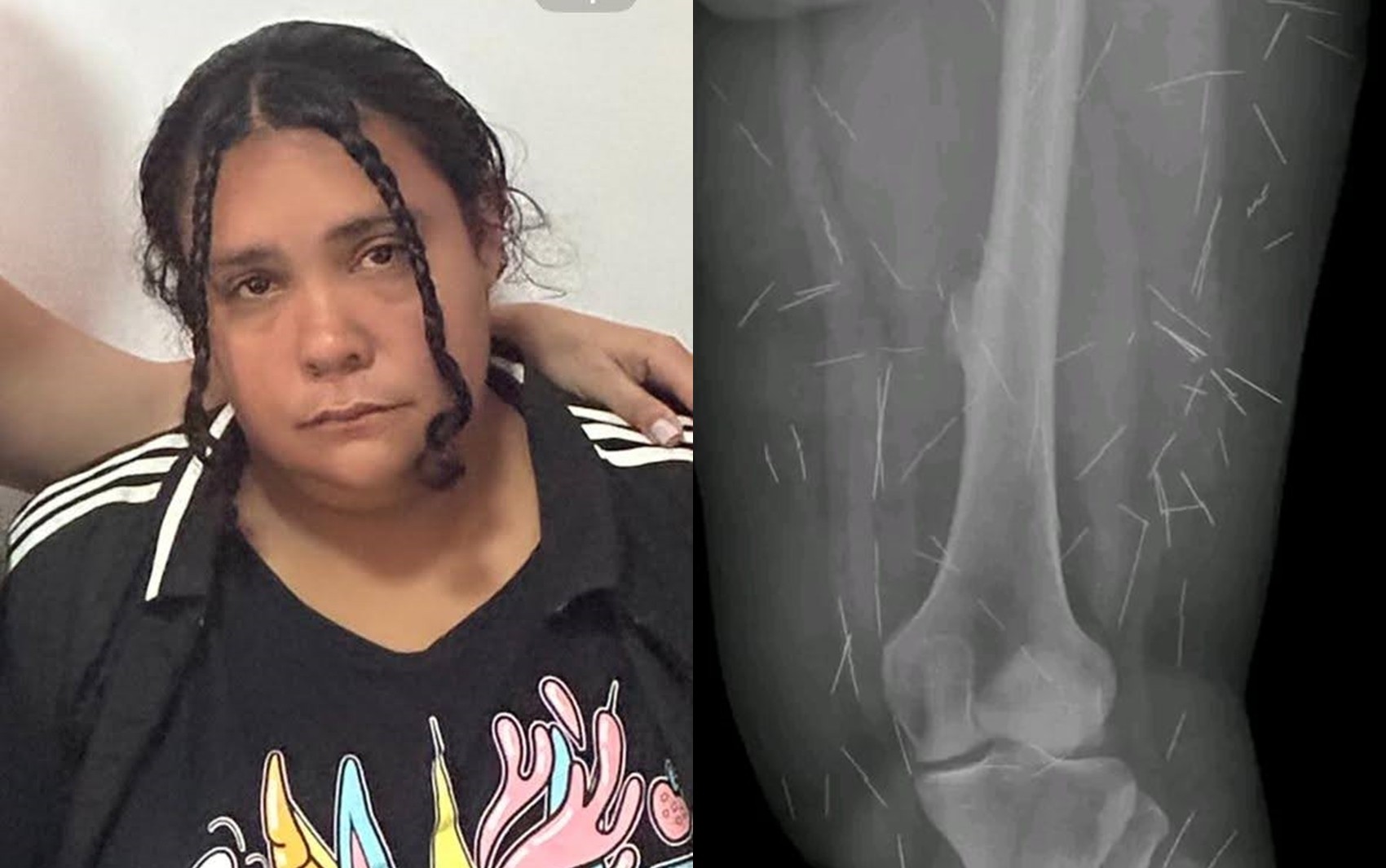 Mulher que fingiu ter 12 anos em SC já foi presa em Goiás ao se passar por criança abusada e com agulhas no corpo para conseguir doações